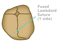 Illustration of lambdoid craniosynostosis