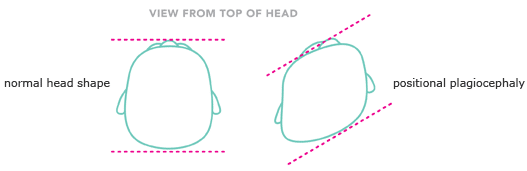 Illustration of normal head shape and positional plagiocephaly