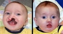 Cleft palate before & after