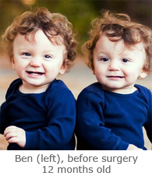 Ben, before surgery, 12 months old