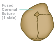Illustration of unicoronal craniosynostosis