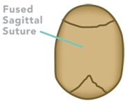 Illustration of sagittal craniosynostosis