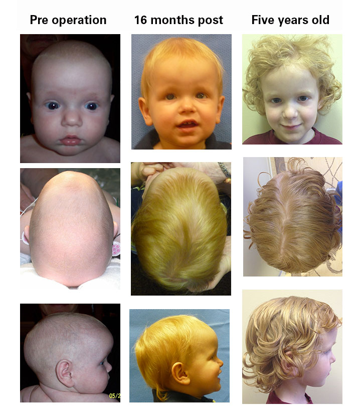 Sagittal craniosynostosis images five-year-old boy
