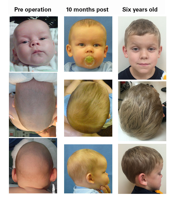 Sagittal craniosynostosis image zix-year-old boy