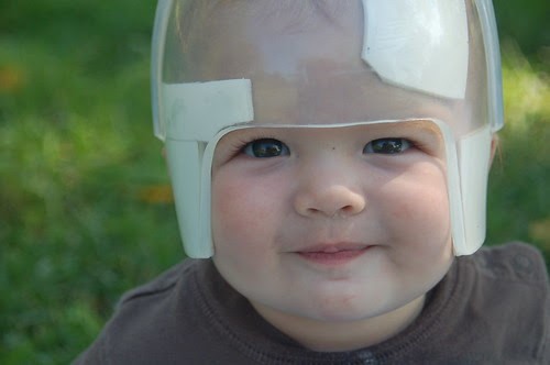 molding helmet on infant