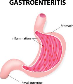 diagram of stomach with gastroenteritis