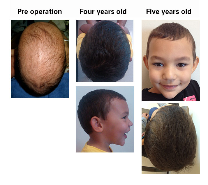 Sagittal craniosynostosis images five-year-old boy