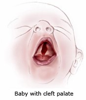 Illustration of baby with cleft palate