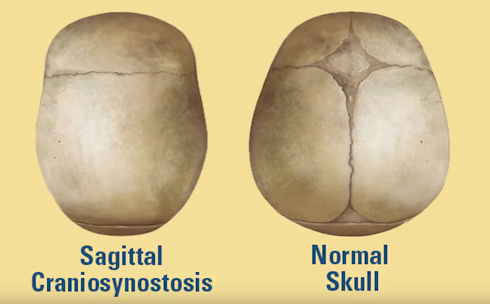 Sagittal craniosynostosis vs. normal skull