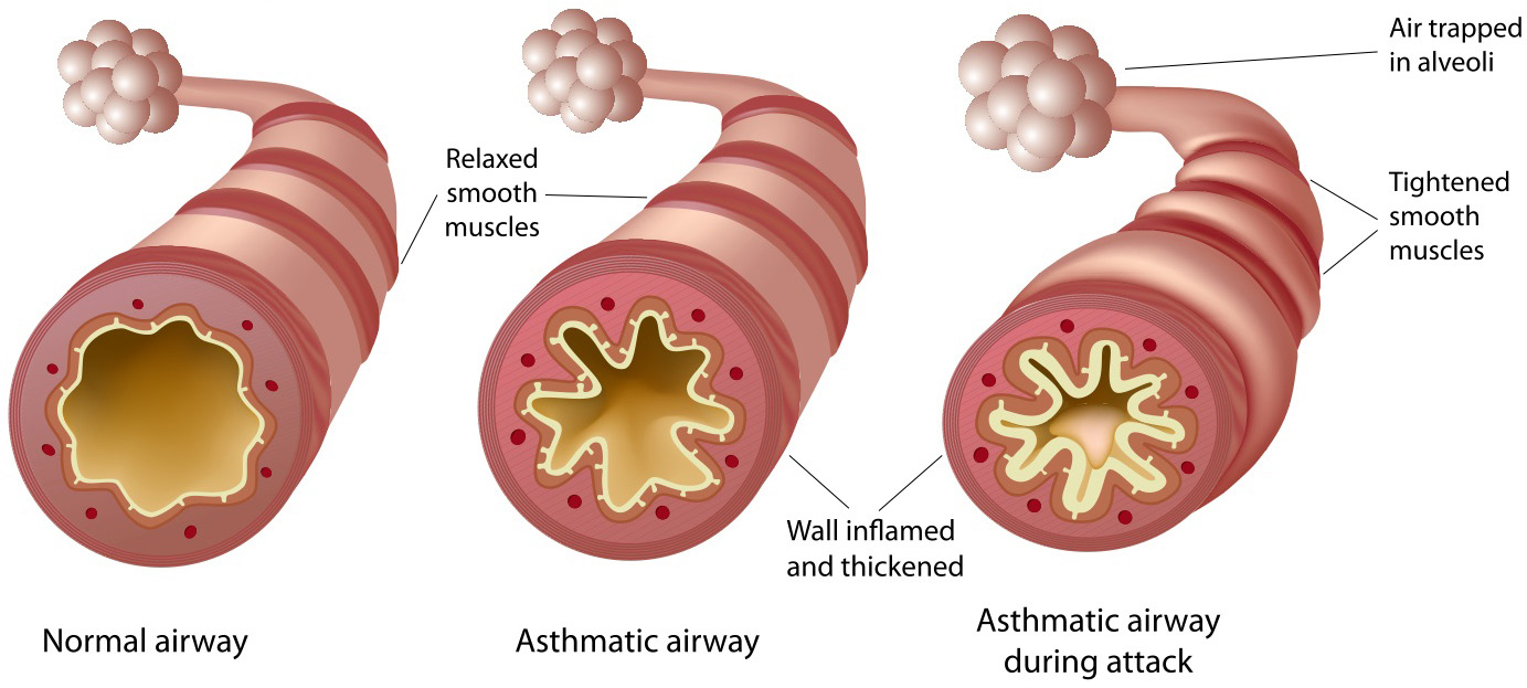 Illustration of normal and asthmatic airways